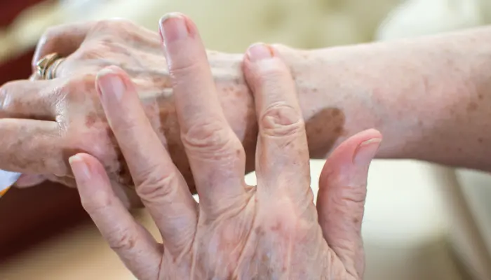 Äldre kvinna smörjer handen.