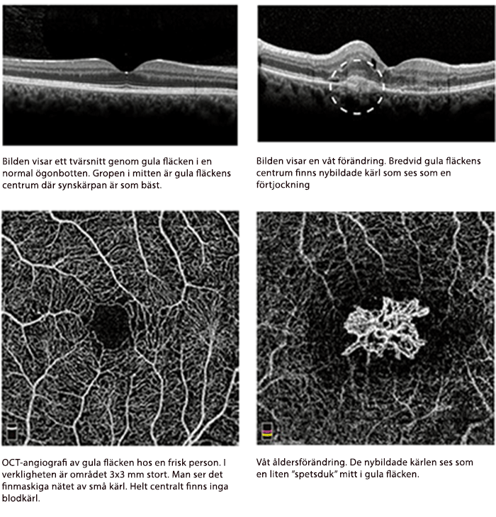 Tvärsnittsbilder från en OCT och en OCT-angio-undersökning