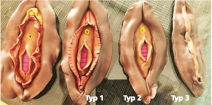 Från vänster en modell av vulva. Modell två till fyra visar olika typer av omskärelse. Typ 1: Förhuden på klitorisoch/eller klitoris tas bort. Typ 2: Klitoris skärs bort samt delar av eller hela de inre och yttre blygdläpparna.Typ 3: Delvis eller fullständigt borttagande av yttre genitalia. Därefter sys de yttre blygdläpparna ihop så attslidöppningen täcks. En liten öppning lämnas längst ner mot anus så att urin och menstruationsblod kan rinna ut.Typ 4: Prickning av klitorisområdet med ett vasst föremål, är också en form av könsstympning.