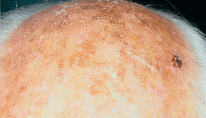 Solskadad hud med många  aktiniska keratoser 